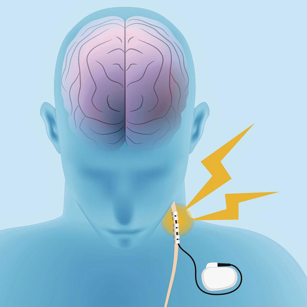 Vagale stimulatie, een interessante optie?