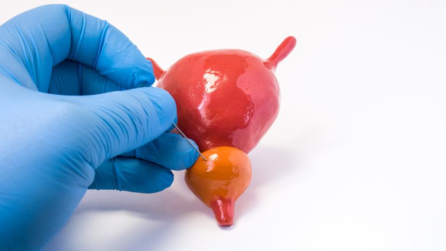 Optimiser la biopsie prostatique