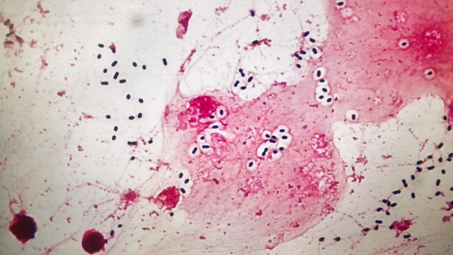Forte hausse des infections à pneumocoques (+17%) et des méningites (+34%)